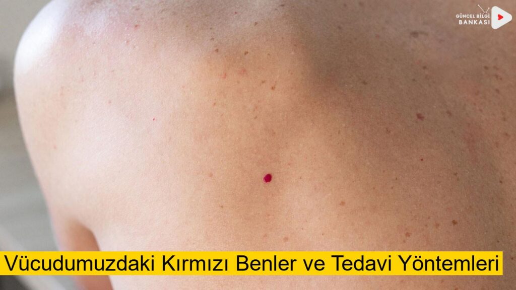 Vücudumuzdaki Kırmızı Benler ve Tedavi Yöntemleri (Güncel 2025)