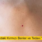 Vücudumuzdaki Kırmızı Benler ve Tedavi Yöntemleri (Güncel 2025)