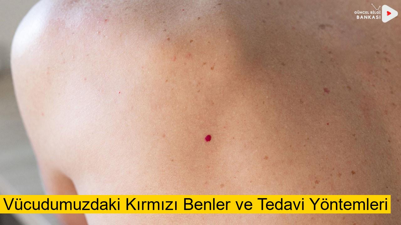 Vücudumuzdaki Kırmızı Benler ve Tedavi Yöntemleri (Güncel 2025)
